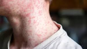 وزارة الصحة تستأنف "التواصل الوبائي" وتعلن عن تسجيل 6 حالات وفاة جديدة بسبب "بوحمرون" 5 telechargement 10 1