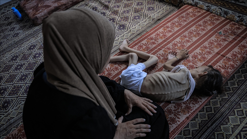 وزارة الصحة في غزة: 5 وفيات جديدة نتيجة المجاعة وسوء التغذية خلال 24 ساعة 2 IMG 9900