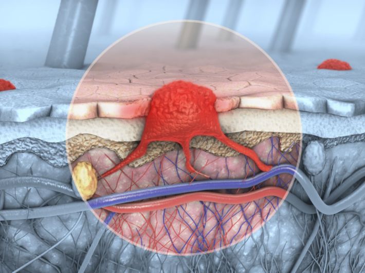سرطان-الخلايا-الصبغية-الميلانوما-كل-ما-تريد-معرفته الشيب درع وقائي!.. كيف يحمي الجسم من السرطان؟