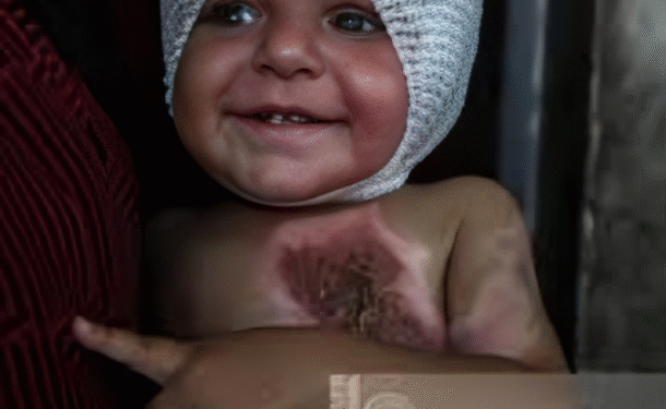 telechargement-11-610x375 بنسبة صادمة.. أطباء يصفون: حروق من الدرجة الثالثة والرابعة تصيب الأطفال في غزة "بشكل لم يوثق من قبل"