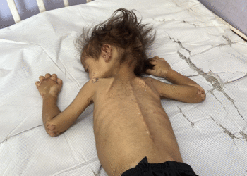الصحة في غزة: ارتفاع ضحايا التجويع الإسرائيلي في غزة إلى 404 فلسطينيين