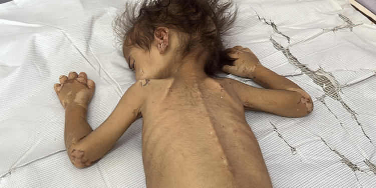 الصحة في غزة: ارتفاع ضحايا التجويع الإسرائيلي في غزة إلى 404 فلسطينيين